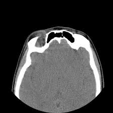 Image result for Dacryoadenitis