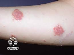 Image result for Eczema nummulare
