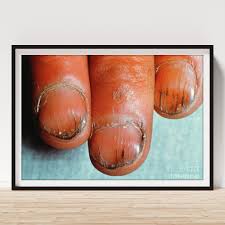 Image result for Koilonychia feet