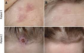 Why does lymphoma treatment cause hair loss? Systemic Rituximab In Multifocal Primary Cutaneous Follicle Centre Lymphoma Html Acta Dermato Venereologica