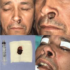 A procedure that uses a magnet, radio waves, and a computer to make a series of detailed pictures of areas inside the body. Verrucous Carcinoma Of The Nasal Cavity