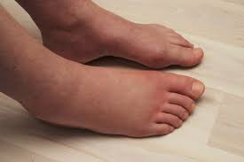 What Causes Swollen Feet and Ankles? &ndash; My FootDr