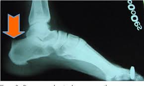 Haglund's deformity occurs when there's frequent pressure on the backs of your heels. Endoscopic Calcaneoplasty For Haglund S Deformity Semantic Scholar