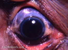 Image result for nevus sclerae