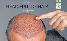 Hair Restoration In Mumbai Hair Transplant Fue Hair Transplant Hair Transplant Cost