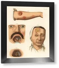 Image result for Tertiary Syphilis