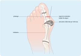 Maybe you would like to learn more about one of these? Jempol Kaki Miring Ma Petite Arie