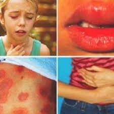 Bubite cu lichid pe maini si picioare. Simptome De Alergie La Copii Care Ar Trebui Sa Ne Atraga Atentia