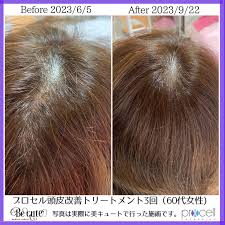 プロセル頭皮改善 | 横浜青葉台シミ毛穴たるみ改善専門のエステ美キュート