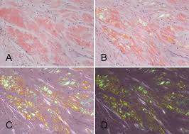 However, biopsies of the bone. Amyloid Historical Aspects Intechopen