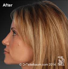Rhinoplasty Before and After Photos by Steven Teitelbaum, MD; Santa Monica,  CA