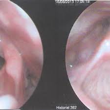 It's done through the mouth under general anesthesia. Steps Of The Wendler S Glottoplasty Procedure Used To Feminize The Download Scientific Diagram