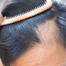 How To Check For Baldness | Health24