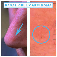 Possible signs and symptoms of these cancers (often only on one side) include: I Have A Spot Or Bump On The Nose What Could It Be Dr Sajjad Rajpar