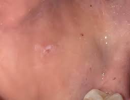 Kleine Rote Flecken Wunden Im Mund Was Ist Das Gesundheit Und Medizin