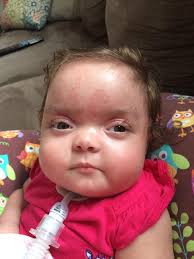 Lennon — Bohring-Opitz Syndrome Foundation, Inc.