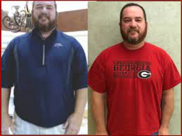 Lap banding for weight loss in an aging population. Jimmy B Lap Band Surgery Palmyra Surgical Bariatric Surgery