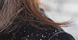 Find out how you can ditch the itch with expert advice from head & shoulders. Can Dandruff Lead To Hair Loss The Link Causes And Treatments
