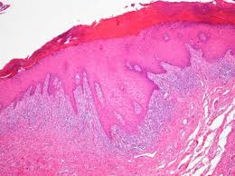 Lichen Sclerosus Im Urogenitalbereich Springerlink