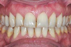 Does Decaf Coffee Still Stain Your Teeth News Stained Teeth Teeth Stain Remover Coffee Stain Removal