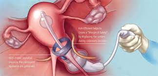 The coopersurgical advincula delineator™ uterine manipulator is indicated to provide delineation of the vaginal fornices and maintain pneumoperitoneum as a uterine manipulator during total. Advincula Delineator Single Use Manipulator Endotherapeutics