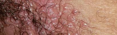 Image result for genital herpes