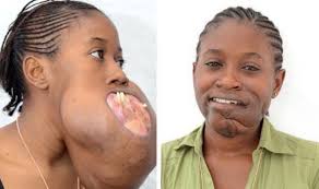 In 2014, 17-year-old Grace from the Democratic Republic of Congo underwent  life-saving surgery to remove a very aggressive tumor. The huge  disfigurement was sprouting from the centre of her lower jaw bone