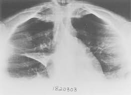 Bilateral hazy pulmonary opacities with indistinct vessels. Thoracic Radiology Imaging Methods Radiographic Signs And Diagnosis Of Chest Disease Radiology Key