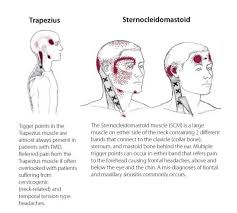 They are a tight lump in an area of where might trigger points occur? What Is Causing My Pain And How Can I Treat It Baskin Clinic