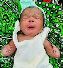 Holt-Oram Syndrome; A Case report