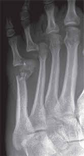 It is the second longest metatarsal. 16 Classification Of Fractures And Dislocations Musculoskeletal Key