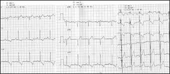 Premature contraction, atrial fibrillation or flatter, decreasing of ecg voltage, depression of • definition: Electrocardiogram Of A Patient With Juvenile Mitral Stenosis