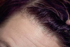 Shadow.those with dark hair may be able to distinguish a shadow or dark spots in their hair follicles. Rogaine New Growth Hairspray And Highheels