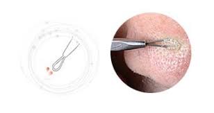 It loosens blackheads making them easier and less painful to release. How To Use A Blackhead Remover