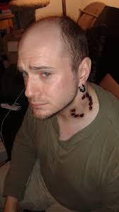 Friend of mine got bit by a werewolf. Or something like that I dunno. Bite mark  work