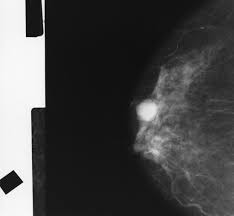 Dense tissue can hide cancers. Mammogram Images Normal Abnormal And Breast Cancer