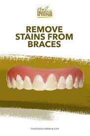 How to remove yellow dye that has stained a white check shirt? How To Remove Stains From Braces How To Remove Stain Teeth Stain Remover Stain Remover
