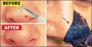 how to remove blackheads at home 12