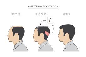 It's likely that elon started taking anti hair loss medication finasteride back in the days but it is even more probably that he didn't start using it during the first signs of his male pattern baldness progression. Inside Elon Musk S Hair Transformation How He Did It Hairguard