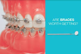 Orthodontics Australia | Your Guide To Lingual Braces [Including The Cost]