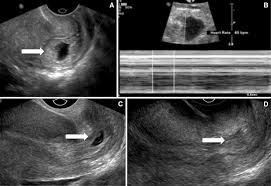 We did not find results for: 26 Year Old G6p0050 Female Presented With Vaginal Bleeding And A Download Scientific Diagram