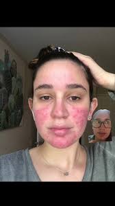 honestly @Apostrophe saved my life tbh. this is an honest review, not  sponsored or anything. Just wanna show the girlies that are going through  something similar a way they can potentionally help it. ...