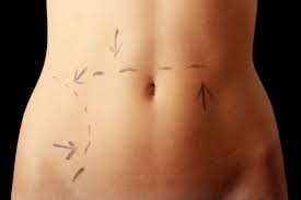 Repairing A Belly Button Hernia After Pregnancy Andrew Trussler Md