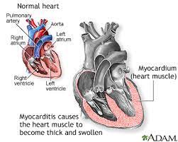 The condition poses a heightened risk to those whose physical activity puts stress on the heart: Myocarditis Medlineplus Medical Encyclopedia