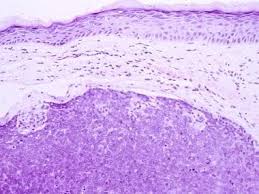 Merkel cell carcinoma is a type of skin cancer. What Are The Histologic Findings Of Merkel Cells And Merkel Cell Carcinoma Mcc