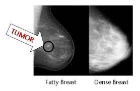 After your staging tests are in this stage, the cancer has spread to the tissues nearby the breast, like the chest wall or skin. Breast Health Thermography Center Of Memphis