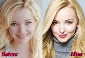 Dove Cameron Plastic Surgery Before And After Plastic Surgery Dove Cameron Celebrity Plastic Surgery