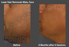 Laser hair removal is a commonly applied medical procedure that has been experimented with for over 20 years, and has entered standard practice in the mid 1990s. Laser Hair Removal Specialists In Sydney Cosmedix Clinics