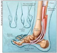 Foot anatomy diagram, foot joint diagram, foot sprain diagram, foot tendons and ligaments pain, leg tendon diagram. Adult Acquired Flatfoot An Overview Hss Foot Ankle