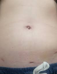 Umbilical Hernia After Laparoscopy Endometriosis Uk
